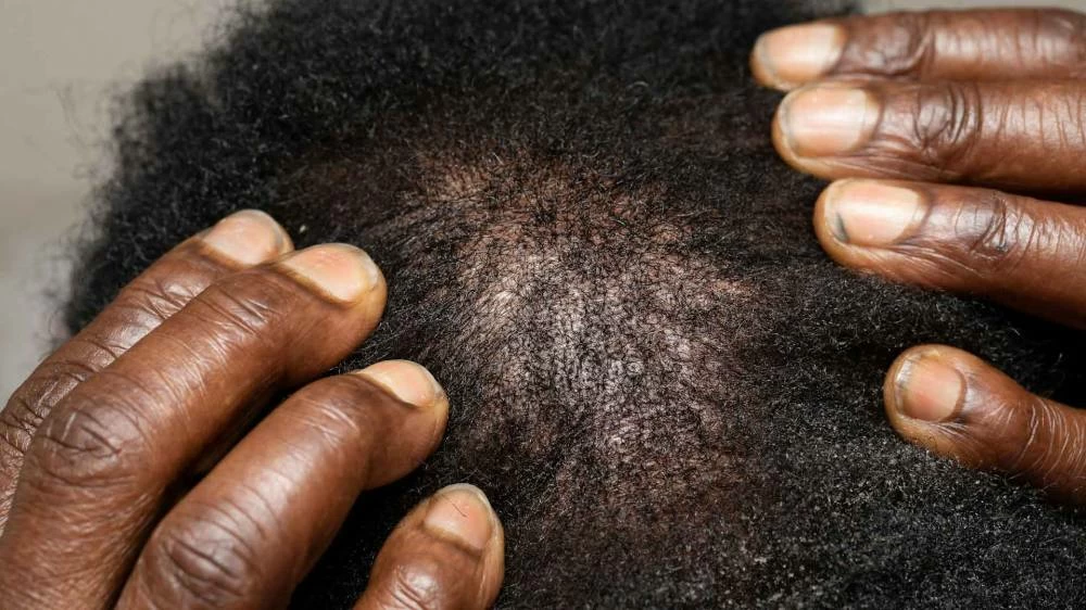 The company was testing its oral minoxidil formulation, called VDPHL01, in over 500 men with mild-to-moderate hair loss pattern. (Photo by Patient Perfect on Unsplash)